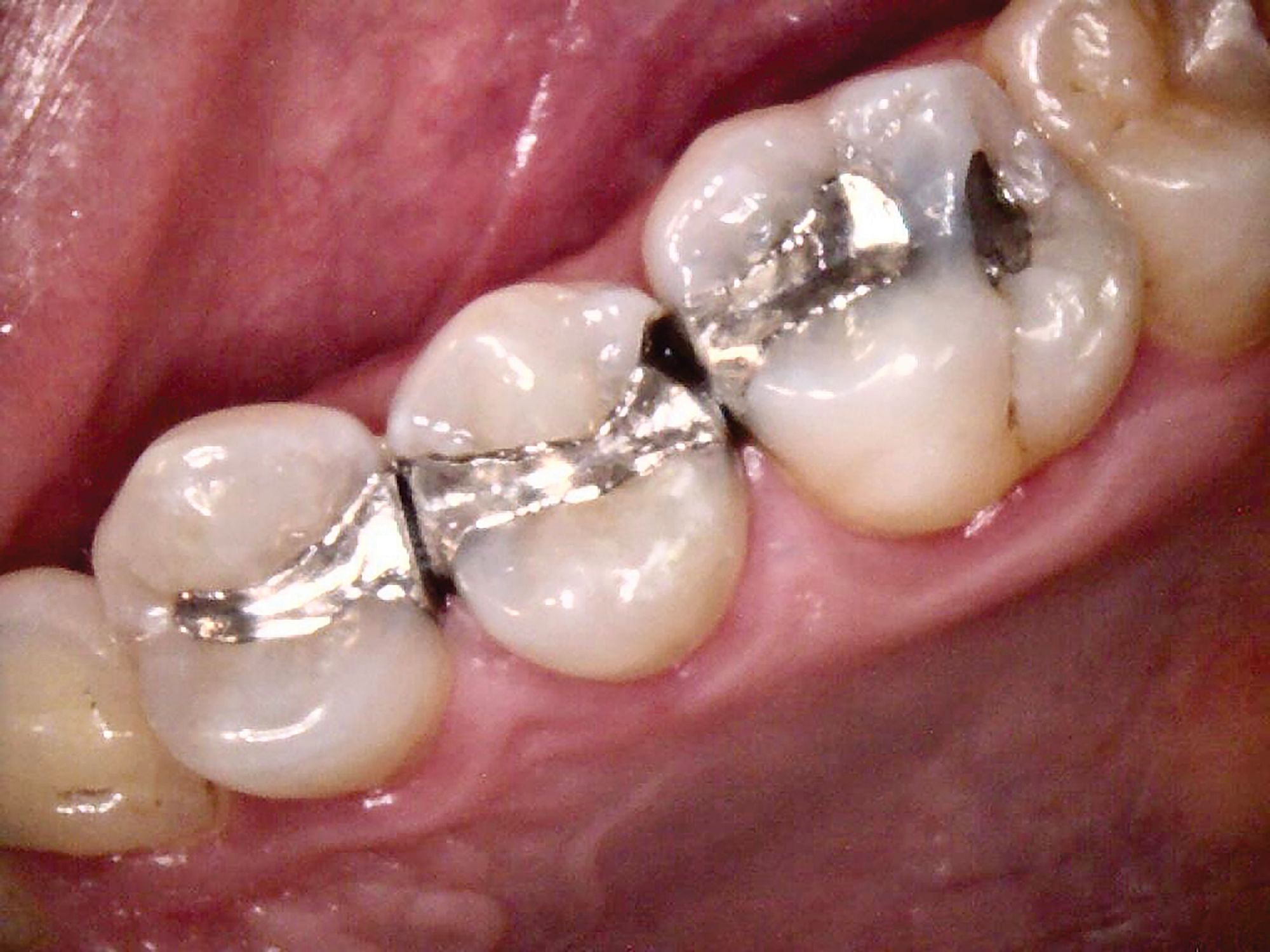 How to Repair Amalgam Restorations With Recurrent Caries